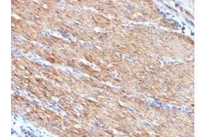 Formalin-fixed, paraffin-embedded human Colon Carcinoma stained with SM-MHC Mouse Monoclonal Antibody (MYH11/923).