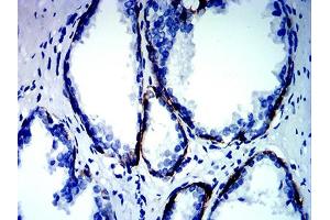 Immunohistochemical analysis of paraffin-embedded prostate cancer tissues using KRT13 mouse mAb with DAB staining.