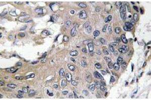 Immunohistochemistry analysis of ApoE Antibody in paraffin-embedded human lung carcinoma tissue. (APOE antibody)