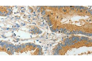 Immunohistochemistry of paraffin-embedded Human colon cancer using BAAT Polyclonal Antibody at dilution of 1:30 (BAAT antibody)
