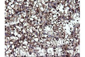 Immunohistochemical staining of paraffin-embedded Carcinoma of Human kidney tissue using anti-MPI mouse monoclonal antibody. (MPI antibody)