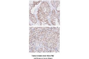 Paraffin embedded sections of human prostate cancer and seminoma tissue were incubated with anti-human TARDBP(1:50) for 2 hours at room temperature. (TARDBP antibody  (AA 1-260))