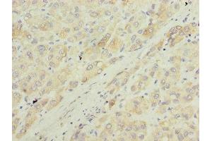 Immunohistochemistry of paraffin-embedded human liver cancer using ABIN7143985 at dilution of 1:100 (Monoamine Oxidase A antibody  (AA 1-300))