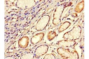Immunohistochemistry of paraffin-embedded human gastric cancer using ABIN7170420 at dilution of 1:100 (SMOC1 antibody  (AA 277-382))