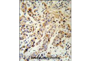 KRT13 Antibody (RB18903) IHC analysis in formalin fixed and paraffin embedded human breast carcinoma followed by peroxidase conjugation of the secondary antibody and DAB staining. (Cytokeratin 13 antibody  (N-Term))