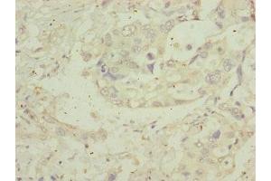 Immunohistochemistry of paraffin-embedded human pancreatic cancer using ABIN7159922 at dilution of 1:100 (MIPEP antibody  (AA 504-713))