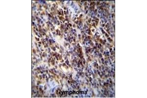 Parp9 Antibody (C-term) (ABIN655613 and ABIN2845094) immunohistochemistry analysis in formalin fixed and paraffin embedded human lymphoma followed by peroxidase conjugation of the secondary antibody and DAB staining. (PARP9 antibody  (AA 599-629))