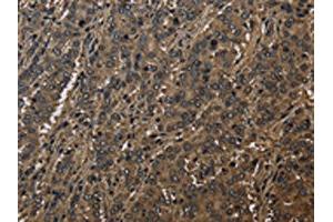 The image on the left is immunohistochemistry of paraffin-embedded Human liver cancer tissue using ABIN7129664(GSTO1 Antibody) at dilution 1/60, on the right is treated with fusion protein. (GSTO1 antibody)