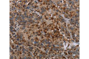Immunohistochemistry of Human liver cancer using MAP3K11 Polyclonal Antibody at dilution of 1:40