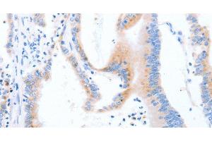 Immunohistochemistry of paraffin-embedded Human colon cancer using STK4 Polyclonal Antibody at dilution of 1:70 (STK4 antibody)