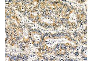 MAGB6 Mouse Monoclonal Antibody at 1/100 staining human colorectal cancer by IHC-P.