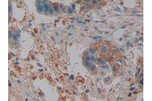 Detection of NGAL in Human Pancreatic cancer Tissue using Polyclonal Antibody to Neutrophil gelatinase-associated lipocalin (NGAL) (Lipocalin 2 antibody  (AA 21-198))