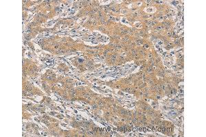 Immunohistochemistry of Human gastric cancer using NFE2L1 Polyclonal Antibody at dilution of 1:30 (NFE2L1 antibody)