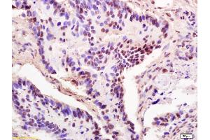 Formalin-fixed and paraffin embedded human colon carcinoma labeled Anti-THOC2 Polyclonal Antibody, Unconjugated (ABIN1387530) at 1:200, followed by conjugation to the secondary antibody and DAB staining (THO Complex 2 antibody  (AA 101-200))