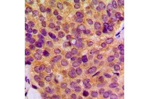 Immunohistochemical analysis of MMP19 staining in human breast cancer formalin fixed paraffin embedded tissue section. (MMP19 antibody  (N-Term))