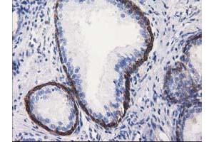 Immunohistochemical staining of paraffin-embedded Carcinoma of Human kidney tissue using anti-ALDH1L1 mouse monoclonal antibody. (ALDH1L1 antibody)