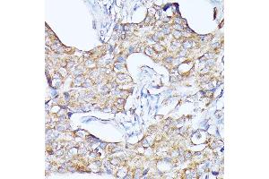 Immunohistochemistry of paraffin-embedded human breast cancer using CTSF antibody (ABIN6127667, ABIN6139225, ABIN6139226 and ABIN6214736) at dilution of 1:100 (40x lens). (Cathepsin F antibody  (AA 270-484))