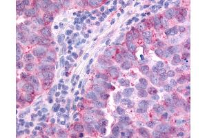 Anti-PAK6 antibody IHC of human Lung, Non-Small Cell Carcinoma. (PAK6 antibody  (Linker Domain))