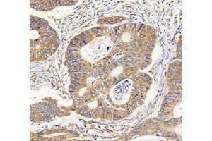 Immunohistochemistry of paraffin embedded human colon cancer using IFIT5 (ABIN7074334) at dilution of 1:500 (200x lens) (IFIT5 antibody)