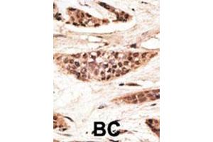 Formalin-fixed and paraffin-embedded human cancer tissue reacted with the primary antibody, which was peroxidase-conjugated to the secondary antibody, followed by AEC staining. (TAP1 antibody  (C-Term))