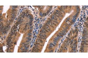 Immunohistochemistry of paraffin-embedded Human colon cancer using EVC2 Polyclonal Antibody at dilution of 1:40 (EVC2 antibody)