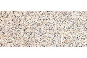 Immunohistochemistry of paraffin-embedded Human prostate cancer tissue using VPS33B Polyclonal Antibody at dilution 1:40 (VPS33B antibody)