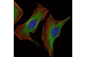 Immunohistochemical analysis of paraffin-embedded ovarian cancer tissues using Insulin Like Growth Factor 2 (IGF2) antibody with DAB staining. (IGF2 antibody  (AA 25-180))