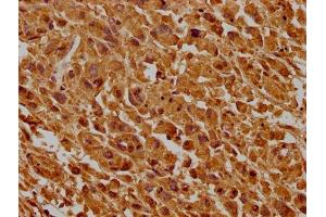 IHC image of ABIN7147175 diluted at 1:500 and staining in paraffin-embedded human lung cancer tissue performed on a Leica BondTM system. (CD63 antibody  (AA 103-203))