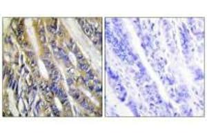Immunohistochemistry analysis of paraffin-embedded human colon carcinoma tissue, using DGKH antibody. (DGKH antibody)