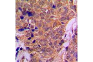 Immunohistochemical analysis of Histone Deacetylase 6 staining in human breast cancer formalin fixed paraffin embedded tissue section. (HDAC6 antibody  (C-Term))