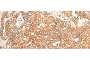 Immunohistochemistry of paraffin-embedded Human liver cancer tissue using CPS1 Polyclonal Antibody at dilution of 1:35(x200) (CPS1 antibody)