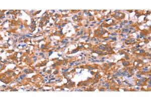 Immunohistochemistry of paraffin-embedded Human thyroid cancer tissue using FAM13B Polyclonal Antibody at dilution 1:30 (FAM13B antibody)