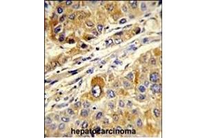 Forlin-fixed and paraffin-embedded hun hepatocarcino reacted with STL Antibody, which was peroxidase-conjugated to the secondary antibody, followed by DAB staining. (MASTL antibody)