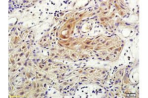 Formalin-fixed and paraffin embedded human vulvar cancer labeled with Anti-Rho C Polyclonal Antibody, Unconjugated (ABIN687157) followed by conjugation to the secondary antibody and DAB staining (RHOC antibody  (AA 101-193))