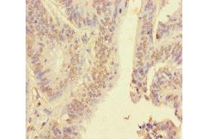 Immunohistochemistry of paraffin-embedded human colon cancer using ABIN7155138 at dilution of 1:100 (HNRNPA2B1 antibody  (AA 1-249))