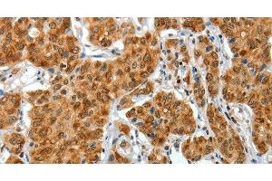 Immunohistochemistry of paraffin-embedded Human lung cancer tissue using COL1A2 Polyclonal Antibody at dilution 1:70 (COL1A2 antibody)
