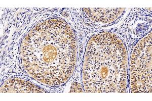 Immunohistochemistry (IHC) image for anti-Tumor Necrosis Factor Receptor Superfamily, Member 10b (TNFRSF10B) (AA 234-435) antibody (ABIN7442663)
