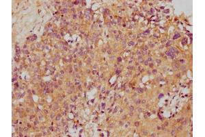 IHC image of ABIN7171217 diluted at 1:500 and staining in paraffin-embedded human ovarian cancer performed on a Leica BondTM system. (STX1A antibody  (AA 1-179))