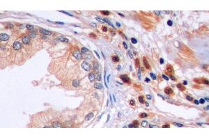 Detection of FAS in Human Prostate Tissue using Polyclonal Antibody to Factor Related Apoptosis (FAS)