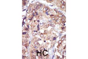 Formalin-fixed and paraffin-embedded human hepatocellular carcinoma tissue reacted with LYN polyclonal antibody  , which was peroxidase-conjugated to the secondary antibody, followed by AEC staining. (LYN antibody  (N-Term))