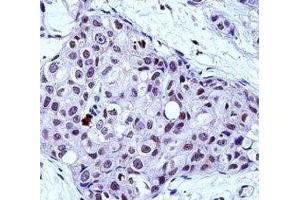 MYB antibody immunohistochemistry analysis in formalin fixed and paraffin embedded human breast carcinoma. (MYB antibody  (AA 419-448))