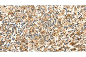 Immunohistochemistry of paraffin-embedded Human gastric cancer using SLC25A11 Polyclonal Antibody at dilution of 1:30 (SLC25A11 antibody)