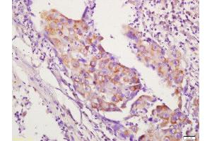 Formalin-fixed and paraffin embedded human lung carcinoma labeled with Anti-CD134 Polyclonal Antibody, Unconjugated  followed by conjugation to the secondary antibody and DAB staining. (TNFRSF4 antibody  (AA 101-200))