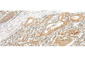 Immunohistochemistry of paraffin-embedded Human esophagus cancer tissue using HLA-G Polyclonal Antibody at dilution of 1:45(x200) (HLAG antibody)