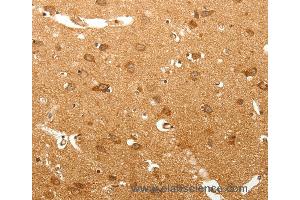Immunohistochemistry of Human lung cancer using MAP1B  Polyclonal Antibody at dilution of 1:60 (MAP1B antibody)