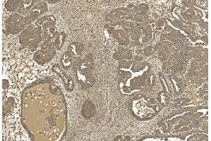 Immunohistochemical analysis of paraffin-embedded Human Ovarian cancer section using Pink1 am1021b. (beta Actin antibody)