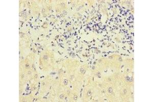 Immunohistochemistry of paraffin-embedded human liver cancer using ABIN7162443 at dilution of 1:100