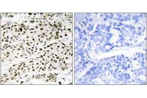 Immunohistochemistry analysis of paraffin-embedded human breast carcinoma tissue, using VPS72 Antibody.