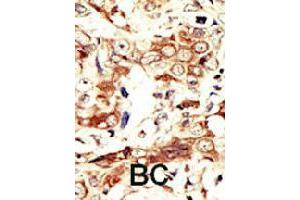 Formalin-fixed and paraffin-embedded human cancer tissue reacted with INSRR polyclonal antibody  , which was peroxidase-conjugated to the secondary antibody, followed by AEC staining. (INSRR antibody  (C-Term))