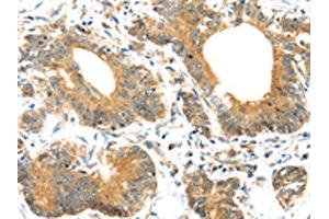 The image on the left is immunohistochemistry of paraffin-embedded Human colorectal cancer tissue using ABIN7192977(UBTD1 Antibody) at dilution 1/30, on the right is treated with synthetic peptide. (UBTD1 antibody)